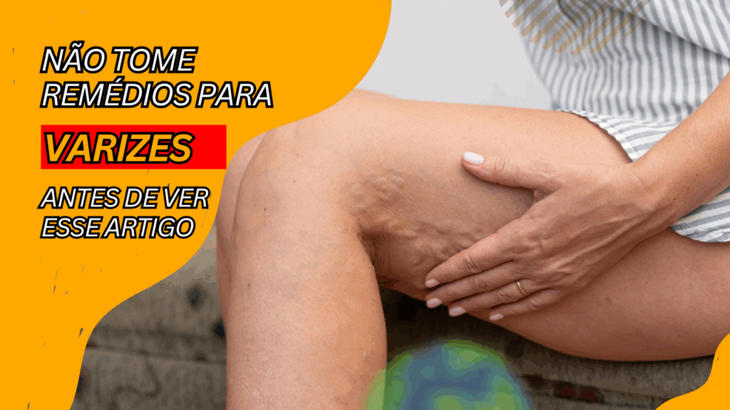 147 Nao Tome Remedios para Varizes Antes de Ver esse Artigo